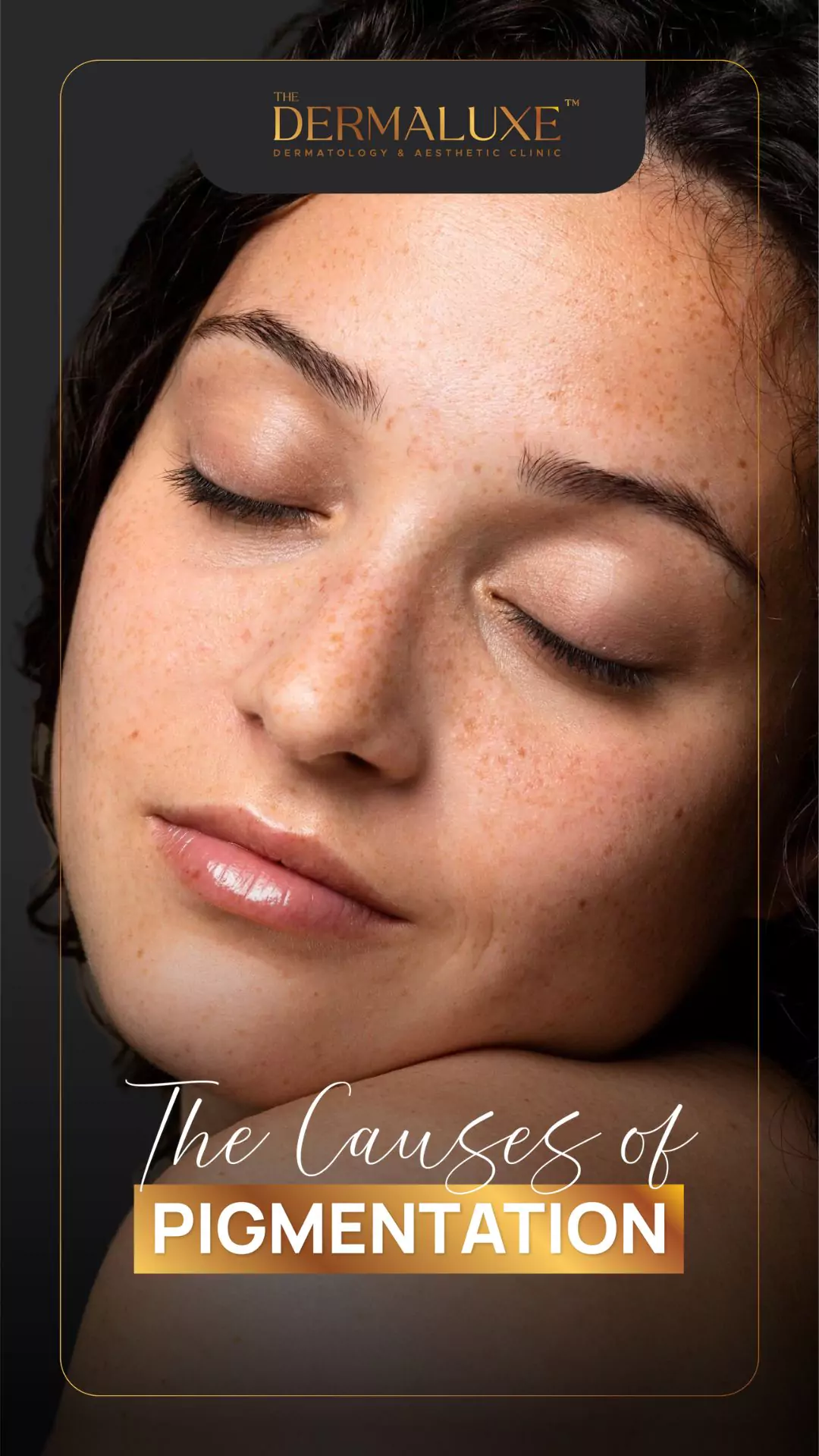 Skin pigmentation_15july
